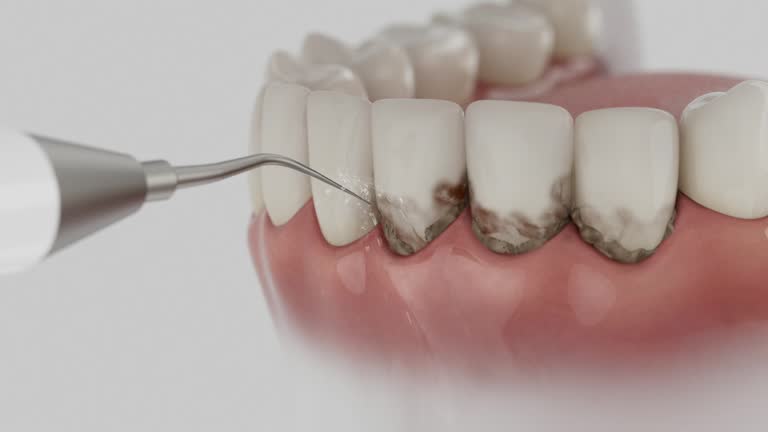 Trusted Dental Veneers service in Berwyn Heights, MD - Dentist Open Now